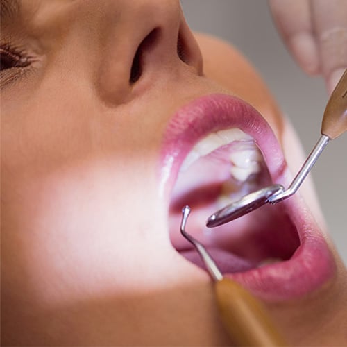 Extraction de dents